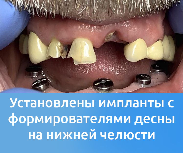 Процесс имплантации зубов в Николаеве в Денталюкс